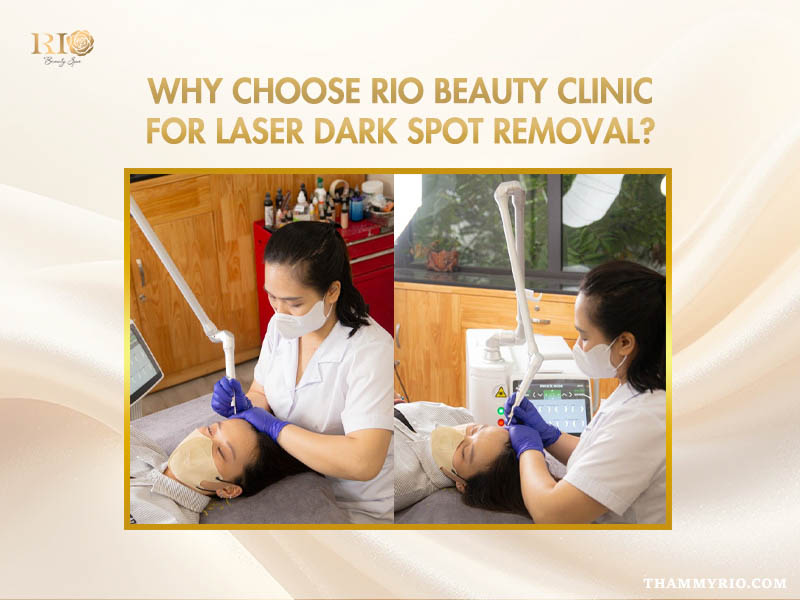 Rio Beauty Clinic laser dark spot removal treatment performed by a specialist using professional laser equipment