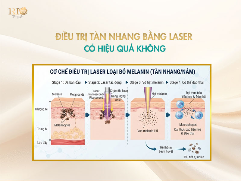 Sơ đồ 4 bước chi tiết giải thích cơ chế loại bỏ hắc sắc tố melanin của phương pháp điều trị bằng laser tàn nhang.