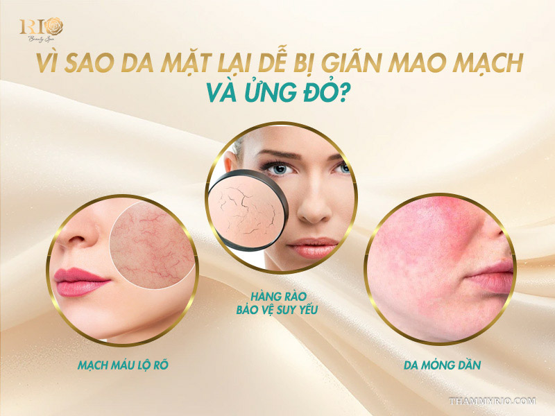 3 biểu hiện mạch máu lộ rõ, hàng rào bảo vệ suy yếu và da mỏng dần cần chăm sóc bằng mặt nạ cho da bị giãn mao mạch