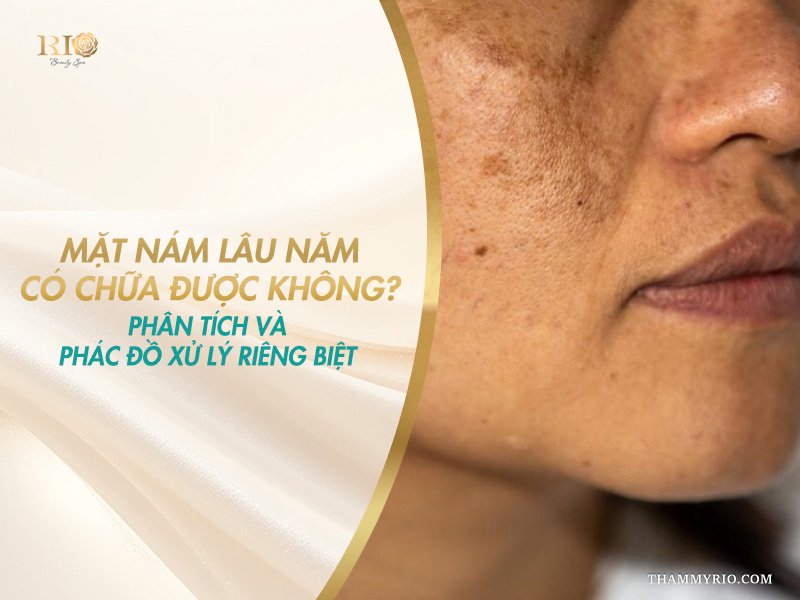 Cận cảnh làn da bị các mảng đốm sẫm màu diện rộng trên banner giải đáp thắc mắc tình trạng mặt nám lâu năm