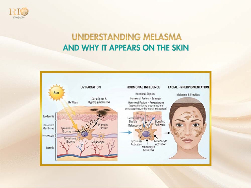 Medical melasma face treatment guide explaining skin pigmentation causes