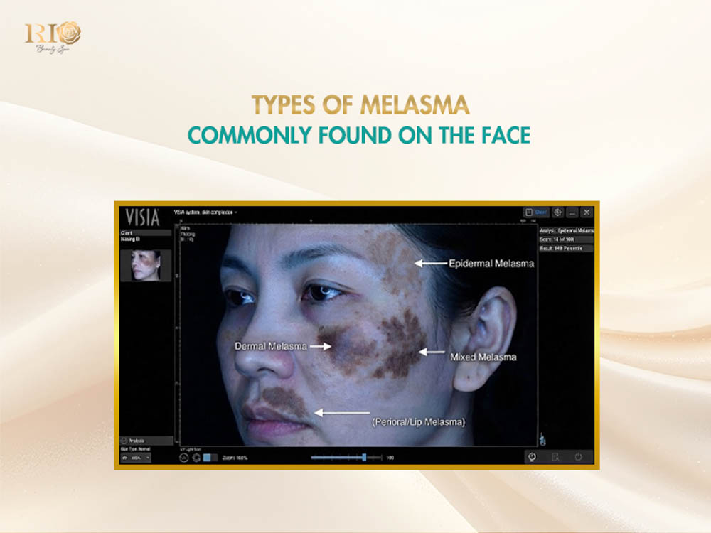 Medical melasma face treatment diagnosis showing types of facial pigmentation