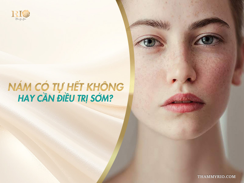 Gương mặt nữ người mẫu rải rác đốm sắc tố trên banner giải đáp thắc mắc nám có tự hết không hay cần điều trị sớm