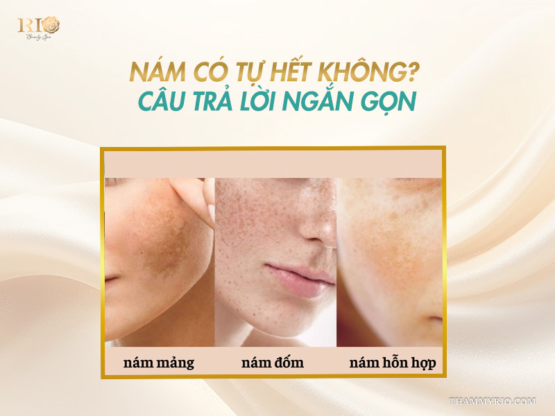 3 ô hình minh họa các loại nám mảng, nám đốm và nám hỗn hợp trên banner phân tích nám có tự hết không