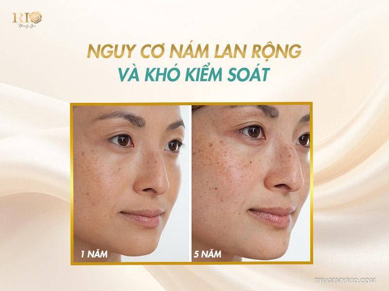 Hình ảnh so sánh sự lan rộng của vết nám trên gò má sau 1 năm và 5 năm không điều trị