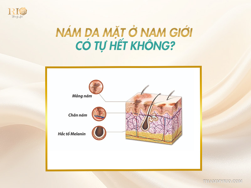 Giải đáp nám da mặt ở nam giới có tự hết không.