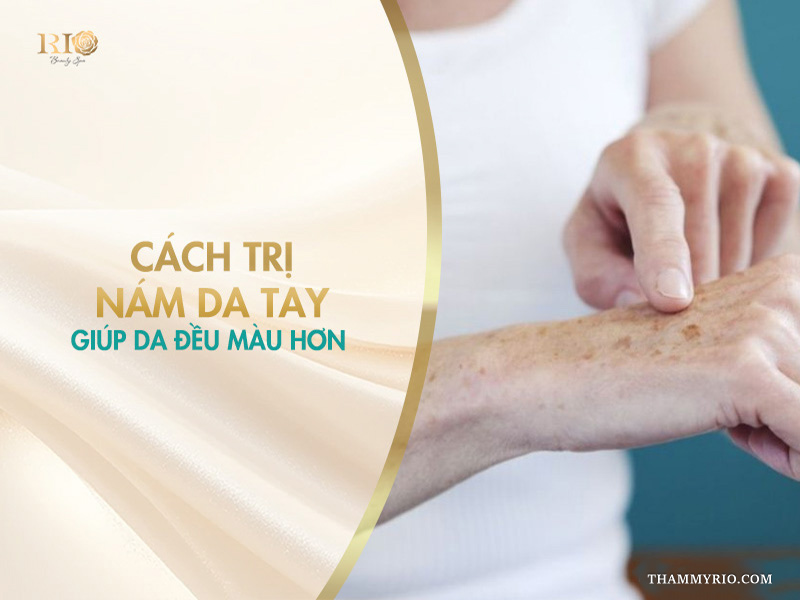 Ngón tay chỉ vào các đốm nám đồi mồi sẫm màu trên bàn tay người lớn tuổi trên banner hướng dẫn cách trị nám da tay