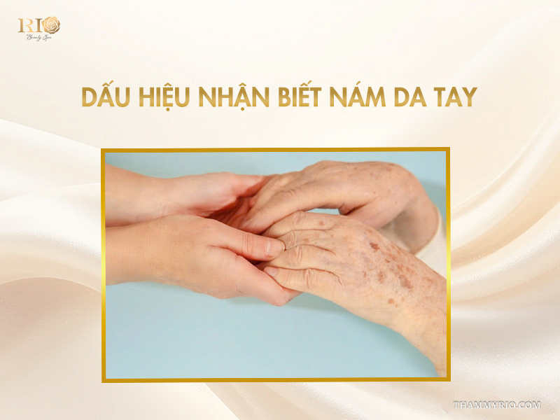 Đôi bàn tay trẻ trung đang nâng niu bàn tay người già xuất hiện nhiều đốm nám đồi mồi tích tụ lâu năm