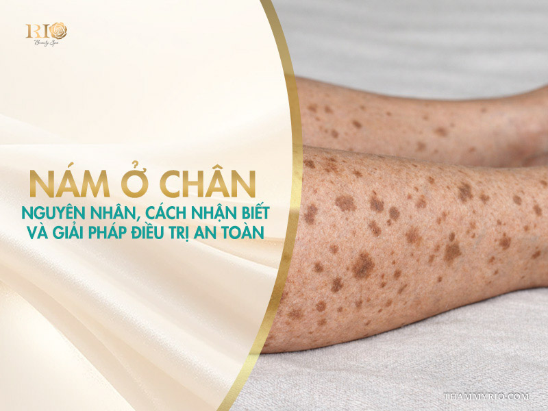 Cận cảnh các đốm đồi mồi sẫm màu phân bố diện rộng trên da cẳng chân trên banner chia sẻ về tình trạng nám ở chân