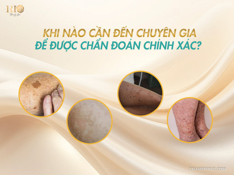 4 khung hình minh họa các dạng tổn thương sắc tố phức tạp cảnh báo thời điểm cần thăm khám nám ở chân cùng chuyên gia