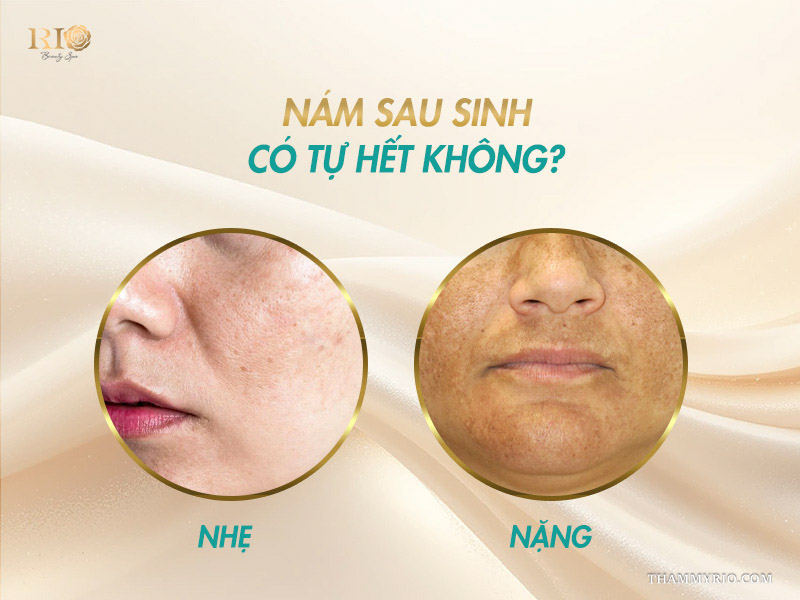 nám sau sinh có tự hết không