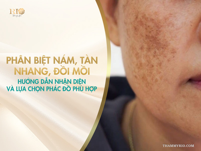 ận cảnh làn da má bị mảng nám và tàn nhang sẫm màu trên banner hướng dẫn phân biệt sắc tố da