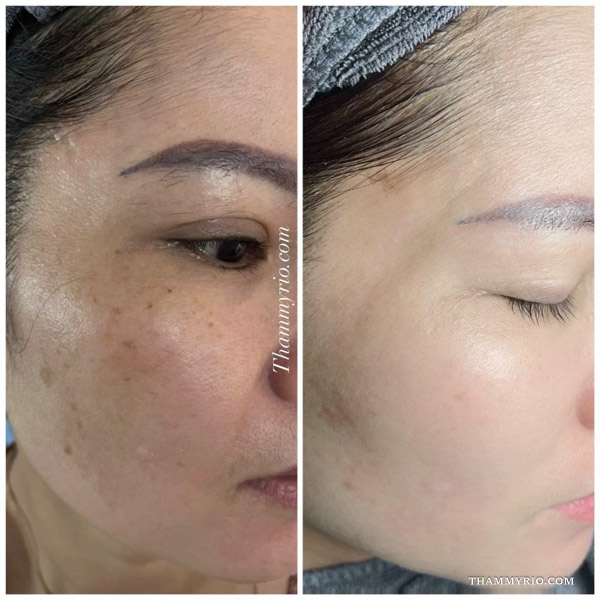 Hình ảnh so sánh trước và sau khi điều trị phân biệt nám tàn nhang đồi mồi thành công tại Thẩm mỹ Rio
