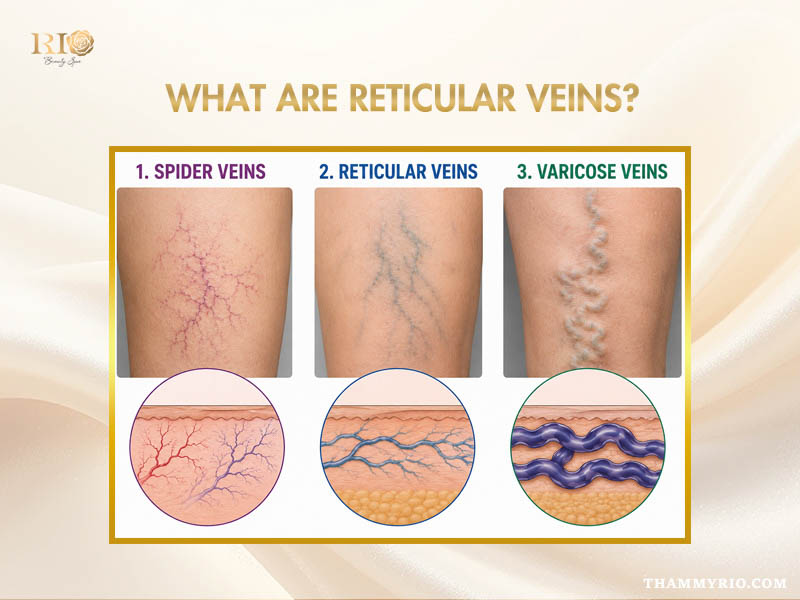Comparison diagram of spider veins, reticular veins, and varicose veins for treatment analysis.