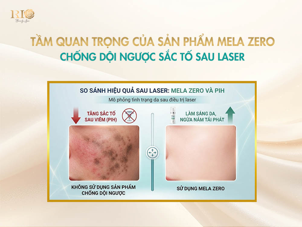 So sánh hiệu quả sử dụng sản phẩm trị nám tàn nhang Mela Zero tại Thẩm mỹ Rio