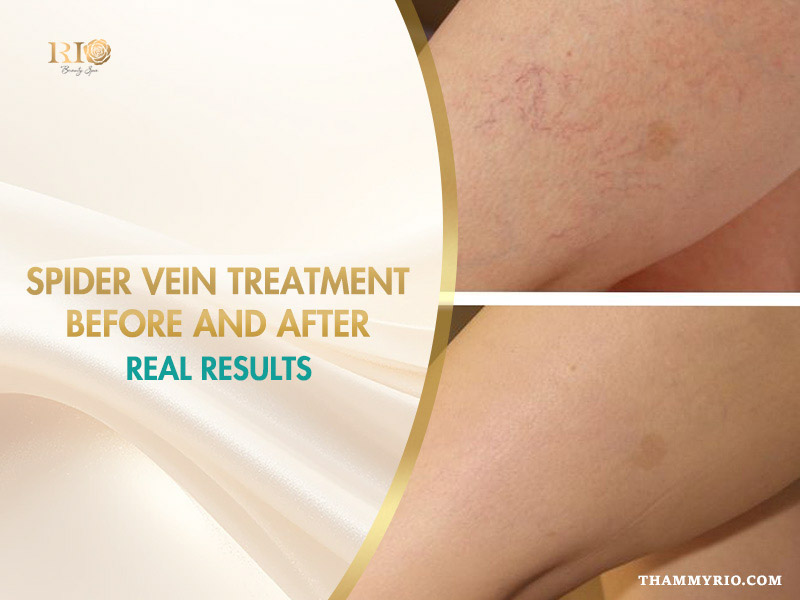 A split image banner titled "Spider vein treatment before and after real results" showing a close-up of a leg with visible red spider veins on top and clearer skin below, branded with Rio Beauty Spa logo.