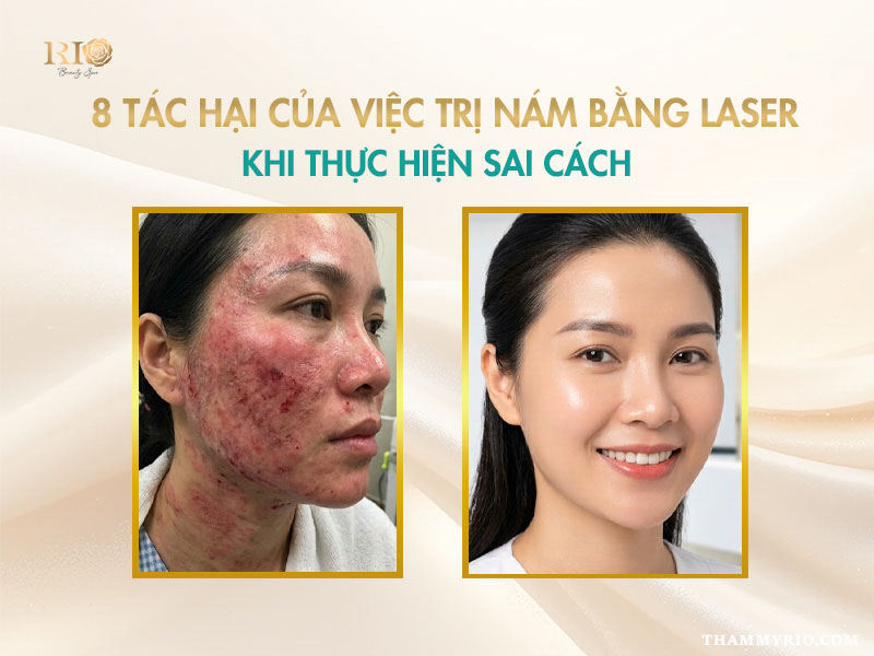 Tác hại của việc trị nám bằng laser khi thực hiện sai cách