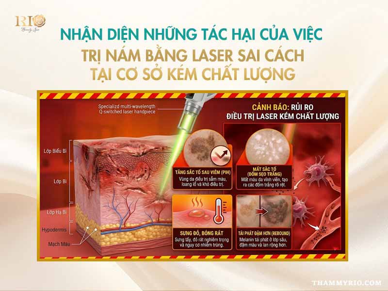 Nhận diện các tác hại của việc trị nám bằng laser sai cách