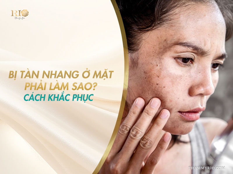 Người phụ nữ lo lắng chạm tay lên vùng gò má xuất hiện nhiều đốm tàn nhang ở mặt trên banner tư vấn cách khắc phục