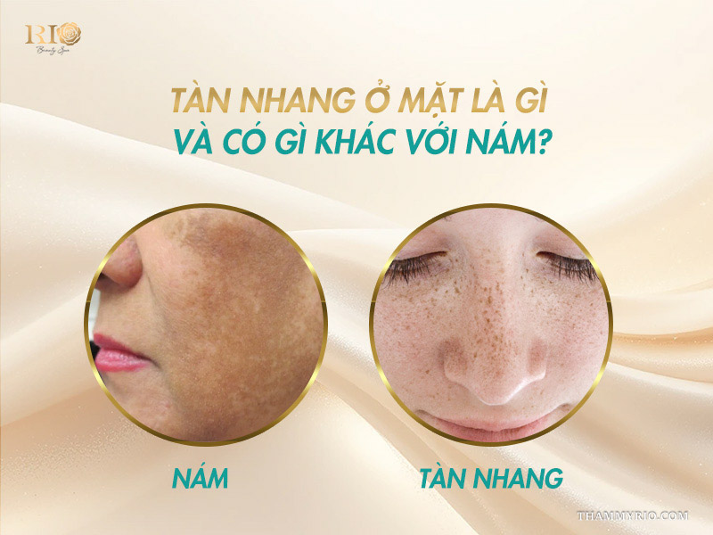 2 ô tròn phân biệt rõ sự khác nhau giữa mảng nám sẫm màu gò má và các đốm tàn nhang ở mặt rải rác trên sống mũi