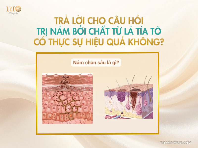Sơ đồ giải phẫu cấu trúc da và cơ chế hình thành nám chân sâu dưới lớp biểu bì trên banner tư vấn trị nám