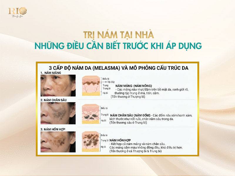Phân biệt 3 cấp độ nám da trước khi áp dụng cách trị nám tại nhà.