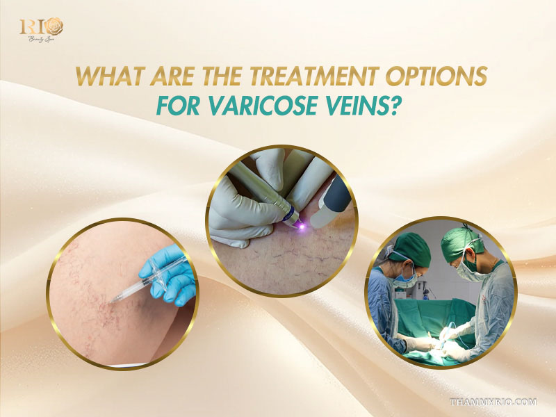 Common varicose vein treatment options overview