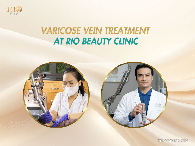 Varicose vein treatment at Rio Beauty Clinic