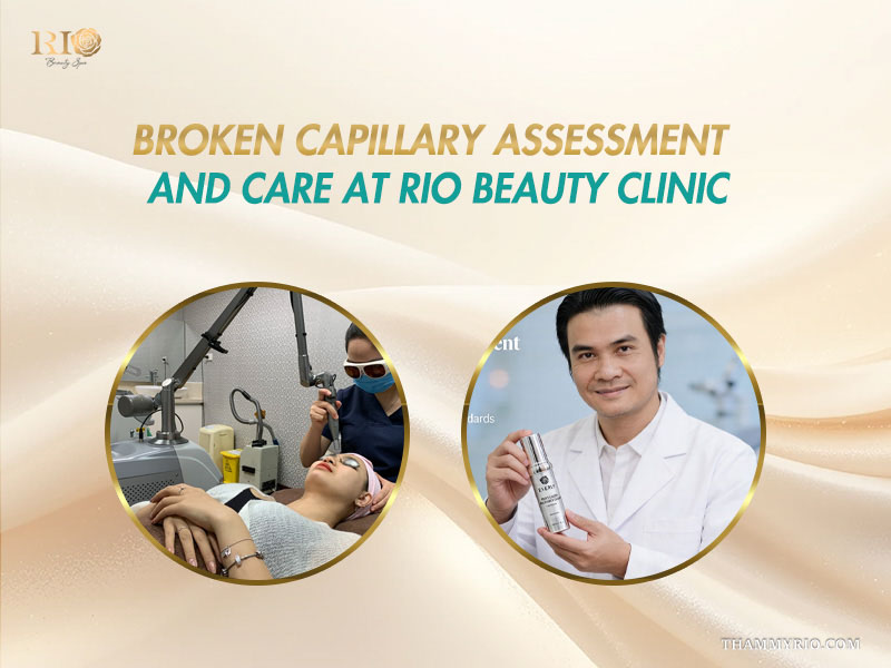 Broken capillary assessment at Rio Beauty Clinic