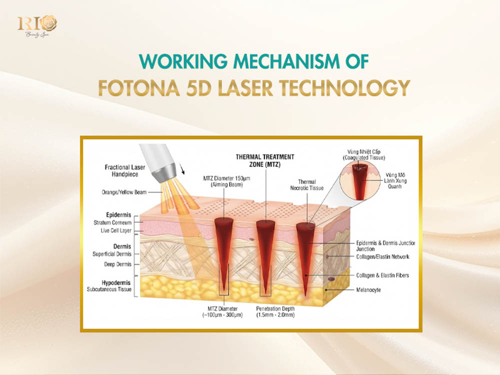 Diagram explaining the multi-layered working mechanism of Fotona 5D laser fractional technology.
