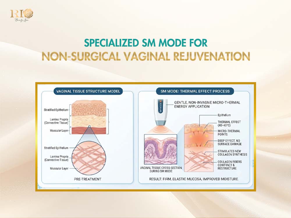 Specialized SM mode for vaginal rejuvenation using technology Fotona 5D laser CO2 fractional.