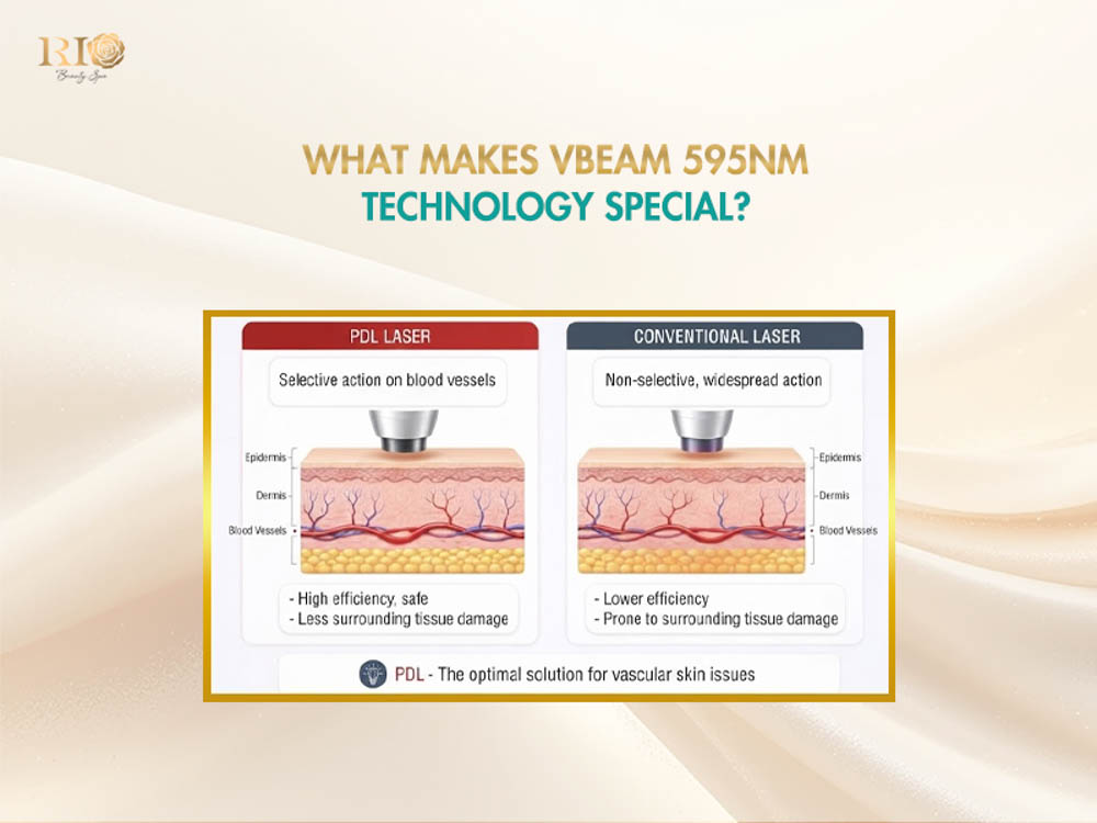 Diagram illustrating selective photothermolysis of PDL laser compared to conventional laser explaining what makes Vbeam Candela 595 nm special