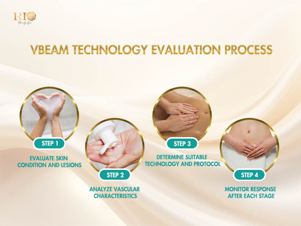 Four-step clinical workflow outlining the diagnostic and monitoring protocol for Vbeam Candela 595 nm treatment