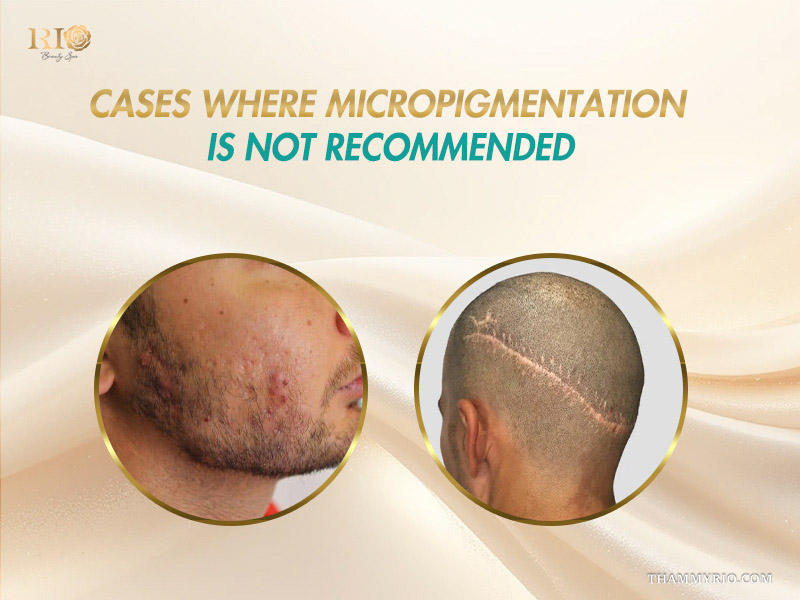 Visual contraindications including active acne and fresh head trauma scars for beard micropigmentation for scars