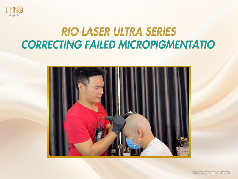 Specialist correcting poorly deposited ink before re-applying beard micropigmentation for scars