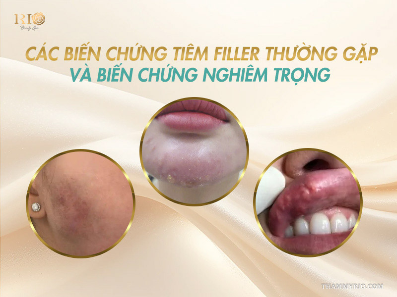 Mô phỏng nguyên nhân gây ra tình trạng biến chứng tiêm filler trên khuôn mặt.