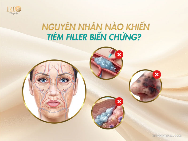 Hướng dẫn những cách phòng tránh biến chứng tiêm filler an toàn.