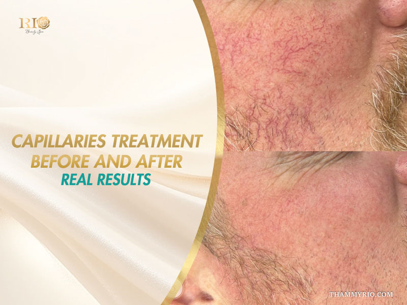 Split-view comparison of intense facial erythema and dilated blood vessels showing real capillaries treatment before and after results