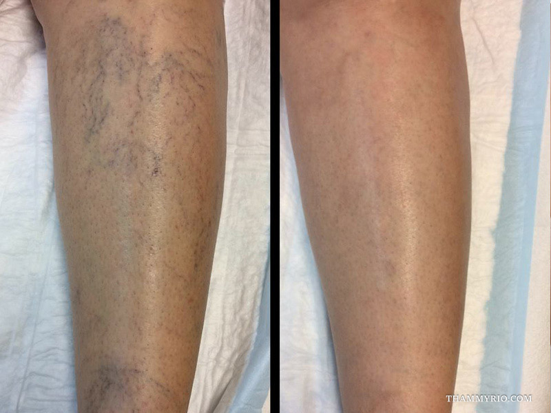Standing front-view comparison of lower legs highlighting transformative capillaries treatment before and after outcomes