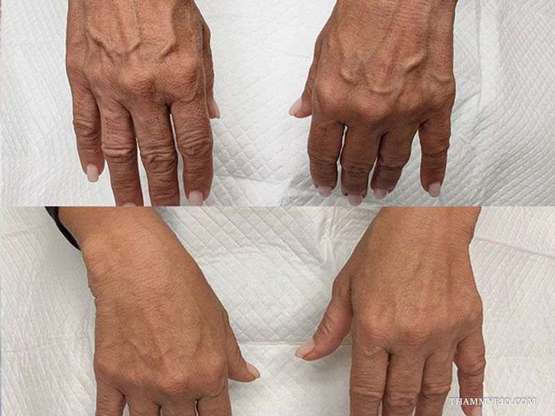 Top and bottom comparison of dorsal hand rejuvenation showcasing capillaries treatment before and after clearance