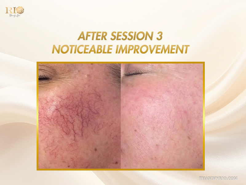 Noticeable improvement on cheek erythema after session 3 in this capillaries treatment before and after gallery