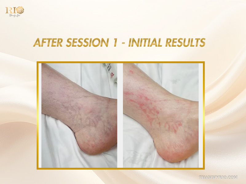Initial vascular response on the ankle after session 1 in capillaries treatment before and after