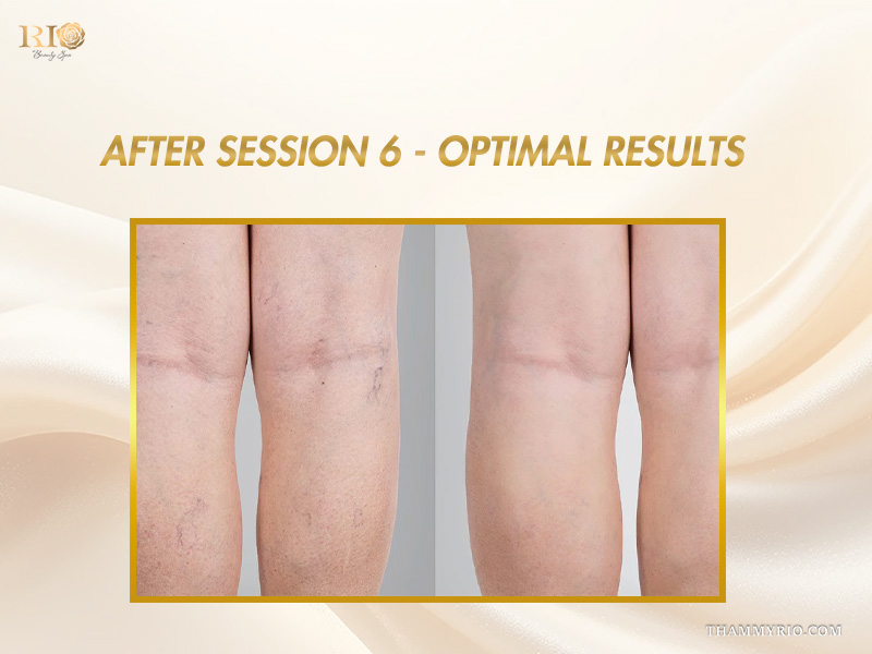 Optimal clearance of leg veins achieved after session 6 in capillaries treatment before and after