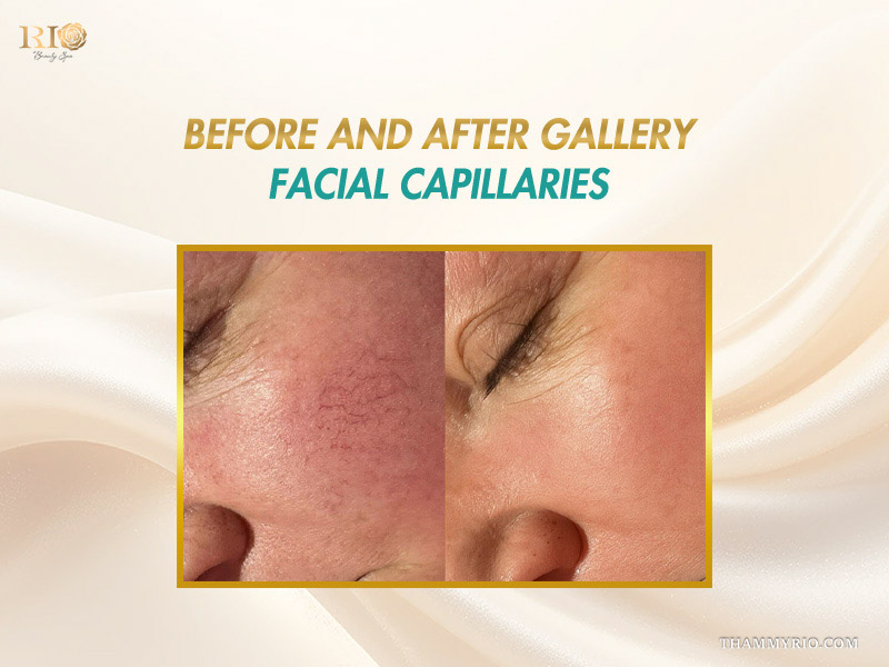 Close-up clinical gallery showcasing visible facial vascular web reduction in capillaries treatment before and after