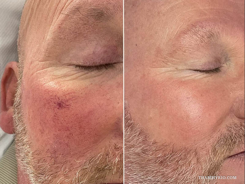 Mature skin telangiectasia clearance demonstrated in this capillaries treatment before and after comparison