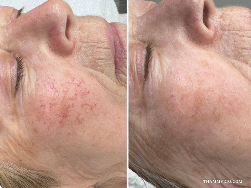 Side-by-side comparison of a male patient's cheek showing remarkable capillaries treatment before and after clearance