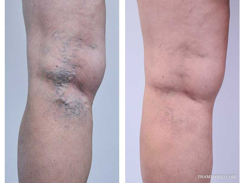 Full bilateral calf view demonstrating comprehensive leg capillaries treatment before and after results