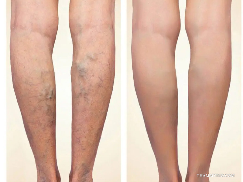 Posterior knee view showing dramatic leg vein clearance in capillaries treatment before and after therapy