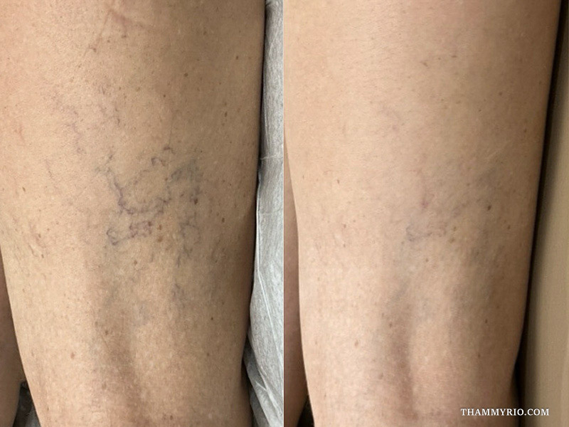 Before and after view of dense outer-leg vascular webs treated with capillaries treatment before and after protocol
