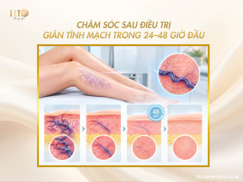 Quy trình chăm sóc sau điều trị giãn tĩnh mạch trong 24 đến 48 giờ đầu.